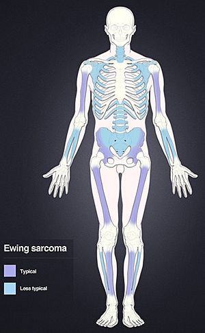Distribution of Ewing's sarcoma