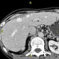 Axial CT anomalous hepatic veins