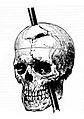 Phineas gage - 1868 skull diagram