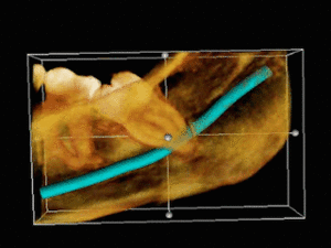 3D CT impacted wisdom tooth