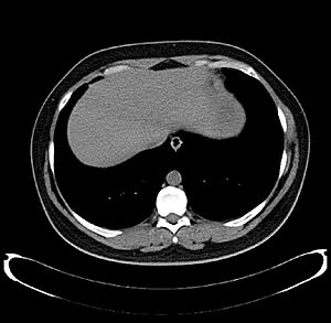 CT Scan Thorax Liver