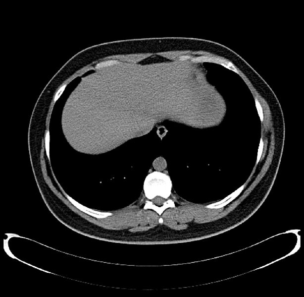 CT Scan Thorax Liver