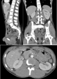 CT of a normal abdomen and pelvis, thumbnail