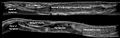 Panoramic ultrasonography of biceps tendon rupture - Annotated