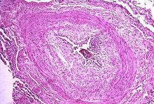 Pulmonary hypertensive arteriopathy (4348170715)