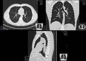 High-resolution computed tomographs of a normal thorax (thumbnail)