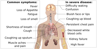 Symptoms of coronavirus disease 2019 4.0