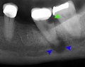 Tooth decay and abscess xray