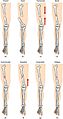 612 Types of Fractures