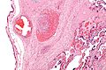 Fetal thrombotic vasculopathy - intermed mag
