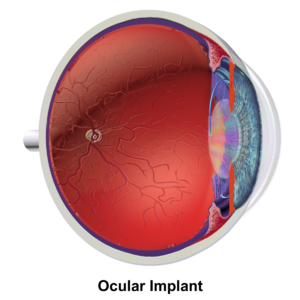 Ocular Implant