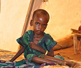 A malnourished child in an MSF treatment tent in Dolo Ado.jpg