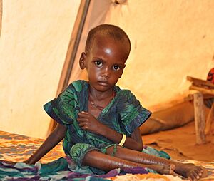 A malnourished child in an MSF treatment tent in Dolo Ado
