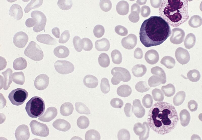 Polycythemia vera, blood smear