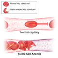Sickle Cell Anemia