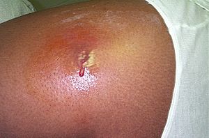 Cutaneous abscess MRSA staphylococcus aureus 7826 lores