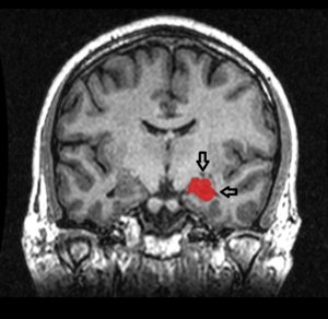 MRI Location Hippocampus up.