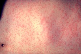 Morbillivirus measles infection