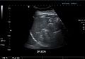 Spleen ultrasound