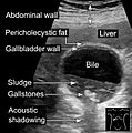 Ultrasonography of sludge and gallstones, annotated