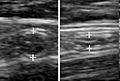 Ultrasonography of a normal appendix without and with compression