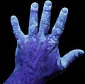 Vitiligo UV 1