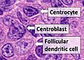 Centrocyte, centroblast and follicular dendritic cell in a follicular lymphoma
