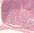 Lymph node with papillary thyroid carcinoma