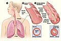 Asthma attack-illustration NIH