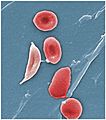 1911 Sickle Cells