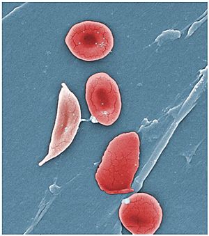 1911 Sickle Cells