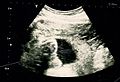 Ultrasonography of abdominal pregnancy
