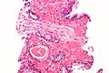 Prostatic adenocarcinoma with perineural invasion