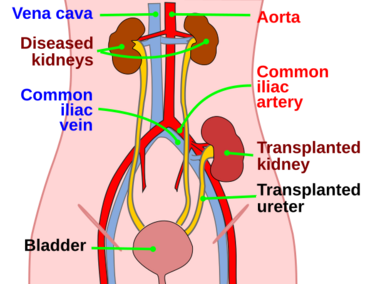 Kidtransplant.svg