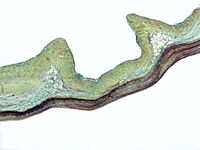 Myxomatous aortic valve