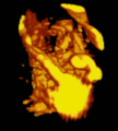 Placenta vasculature 3D power doppler 00001