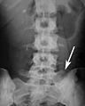 Sacralization of the fifth lumbar vertebra
