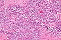 Small cell carcinoma of the ovary hypercalcemic type - high mag