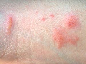 Poison ivy contact dermatitis