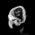 Parasagittal MRI of human head in patient with benign familial macrocephaly prior to brain injury (ANIMATED)
