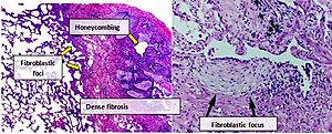 Photomicrograph of usual interstitial pneumonia