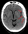 Ct-scan of the brain with an subdural hematoma