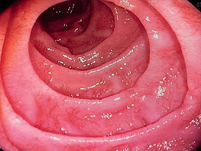 Coeliac disease endoscopy.jpg