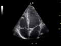 Ultrasound of human heart apical 4-cahmber view