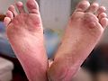 Friction Blisters On Human Foot