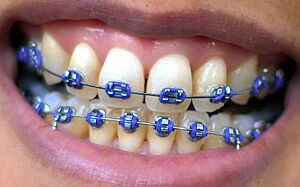 Braces smile purple