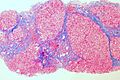 Cirrhosis of the liver (trichrome stain) (5690946257)
