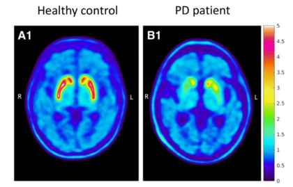 Reduced striatal 18F-DOPA uptake