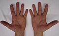 Characteristic rash of hand, foot, and mouth disease, on human hands