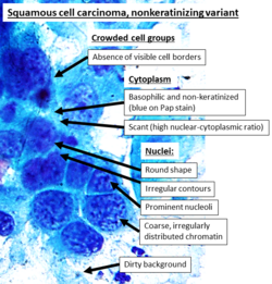 Cytopathology of nonkeratinizing squamous cell carcinoma